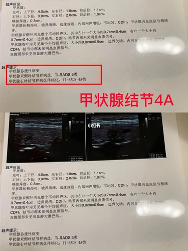 甲状腺结节钙化怎么办? 甲状腺结节钙化怎么办?