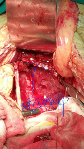 卵巢癌术后一年复发了怎么办 卵巢癌术后一年复发了怎么办