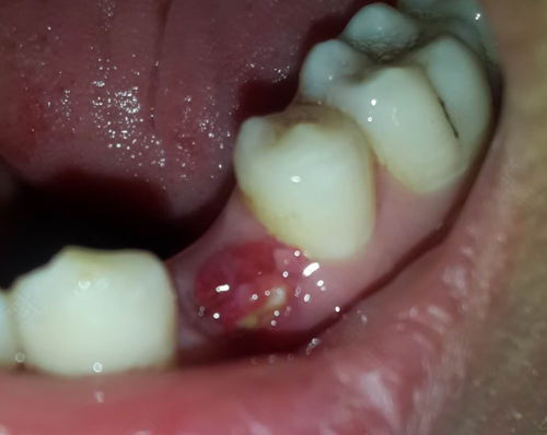 拔牙后一定要种牙吗? 拔牙后一定要种牙吗?