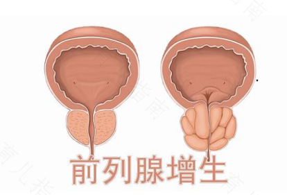 前列腺炎怎么治疗 前列腺炎怎么治疗