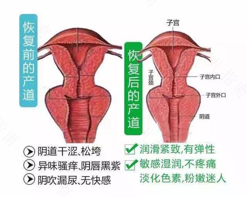 产后妈妈快速恢复阴道紧致有妙招