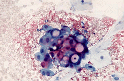 衣原体感染引起咳嗽怎么治疗 衣原体感染引起咳嗽怎么治疗