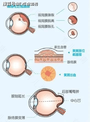近视275度是什么概念 近视275度是什么概念