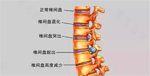 腰椎间盘痛怎么办?
