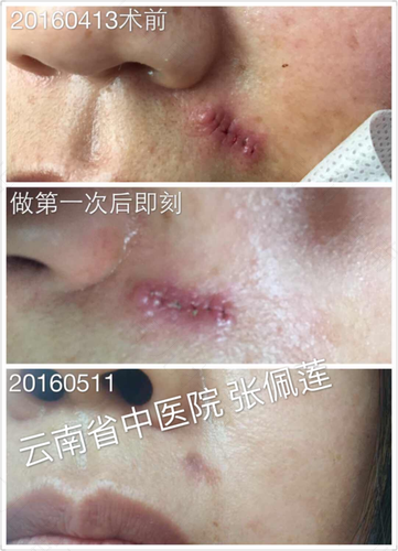 祛痣手术后不能吃什么