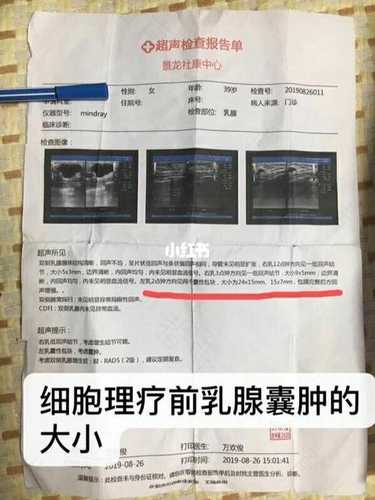 乳腺右边有囊肿怎么办 乳腺右边有囊肿怎么办