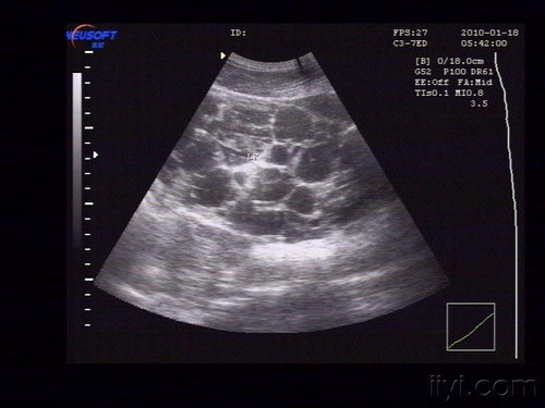 怎么确定是不是多囊肾