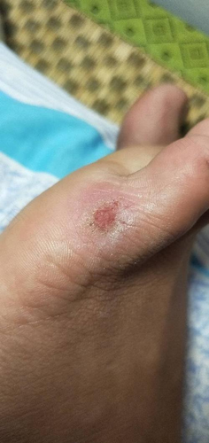 伤口部位痒是怎么回事 伤口部位痒是怎么回事