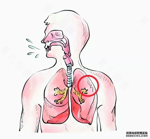 支气管炎咳嗽怎么办 支气管炎咳嗽怎么办