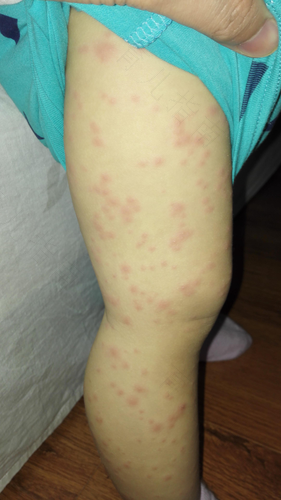 发烧出皮疹怎么回事 发烧出皮疹怎么回事