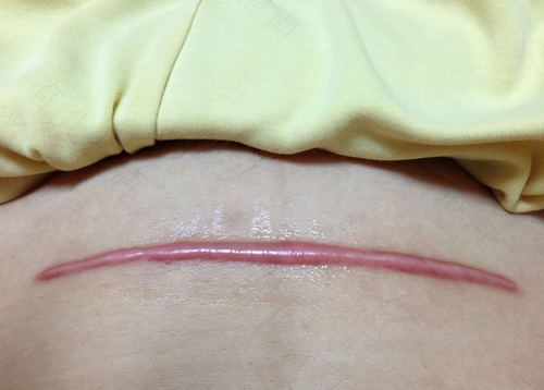 剖腹产第九天伤口痒怎么回事 剖腹产第九天伤口痒怎么回事