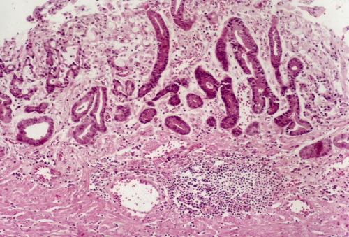 小孩病毒性肠炎症状及治疗 小孩病毒性肠炎症状及治疗