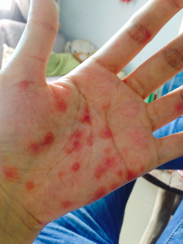 手上红疹怎么治疗 手上红疹怎么治疗