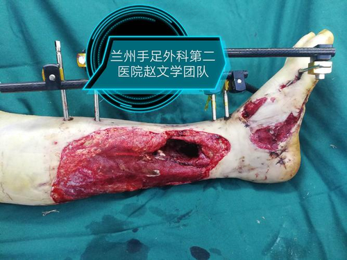 小腿骨折手术后六个月可以正常走路了吗? 小腿骨折手术后六个月可以正常走路了吗?