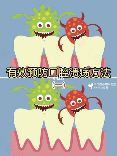 预防口腔溃疡的方法有哪些?