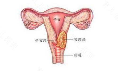 什么样的女性容易得子宫癌 什么样的女性容易得子宫癌