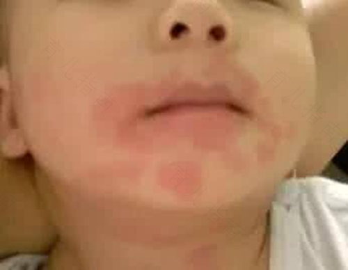 皮肤过敏能吃牛奶和鸡蛋吗 皮肤过敏能吃牛奶和鸡蛋吗