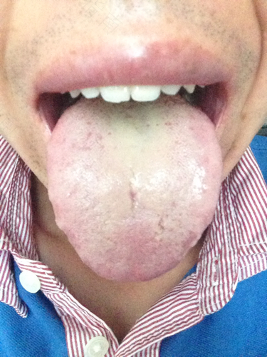 舌苔发黄有口臭怎么办 舌苔发黄有口臭怎么办