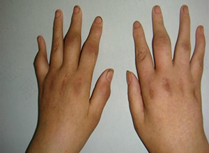 风湿病怎么治最好的方法