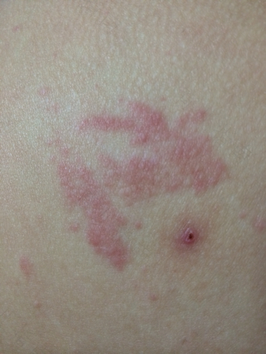 屁股沟疼还肿了是怎么回事 屁股沟疼还肿了是怎么回事