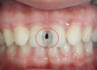 大门牙蛀牙有洞怎么办 大门牙蛀牙有洞怎么办