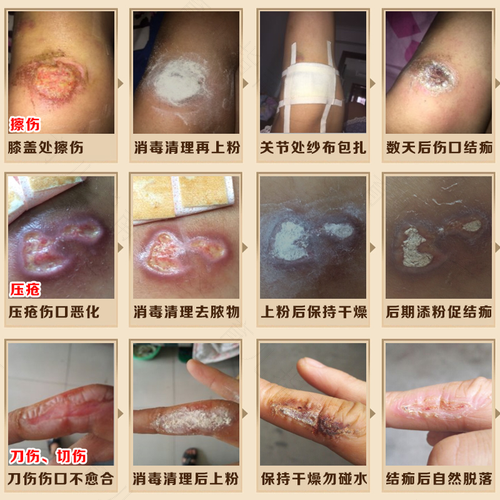 怎么促进伤口愈合结痂 怎么促进伤口愈合结痂