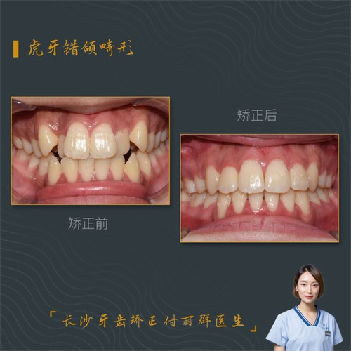 30岁牙齿矫正的危害有哪些? 30岁牙齿矫正的危害有哪些?