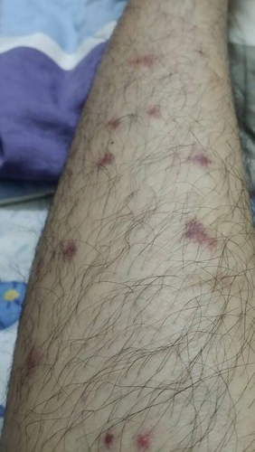 得了梅毒潜伏期是多久 得了梅毒潜伏期是多久