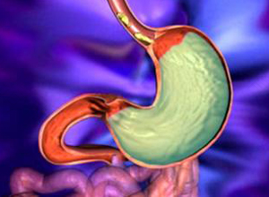 胆汁反流可以彻底治愈吗