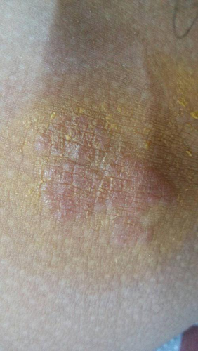 阴囊湿疹可以吃鸡蛋吗? 阴囊湿疹可以吃鸡蛋吗?