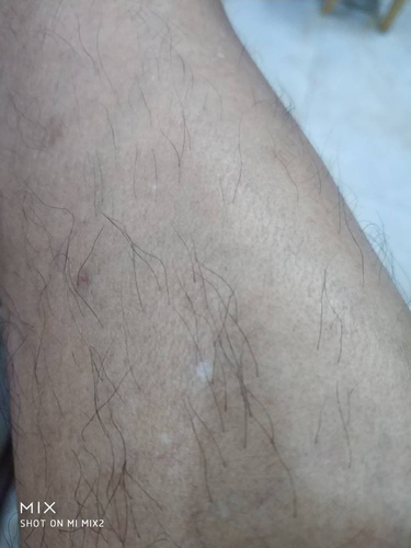 小腿上有很多白斑图片