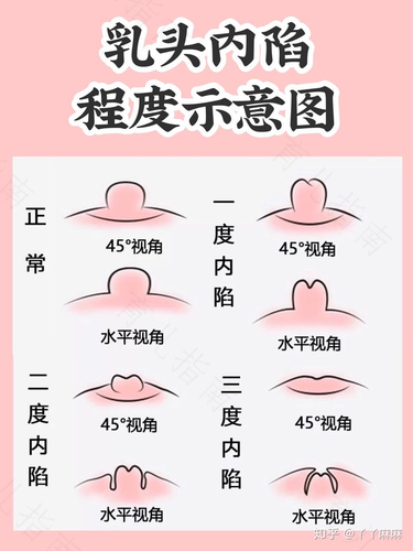 乳头经常疼是什么原因需要治疗吗 乳头经常疼是什么原因需要治疗吗