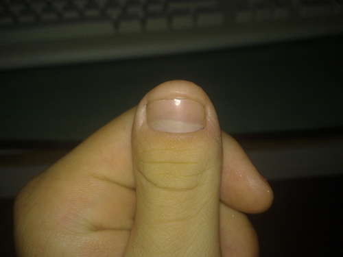 手指甲短怎么办?