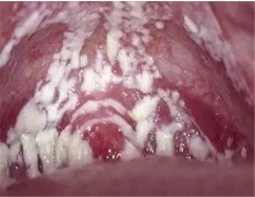 念珠菌病是什么症状 念珠菌病是什么症状