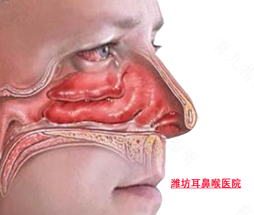 慢性鼻炎出血怎么治疗