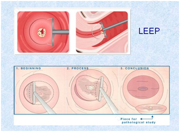 宫颈锥切手术后会出现什么问题 宫颈锥切手术后会出现什么问题
