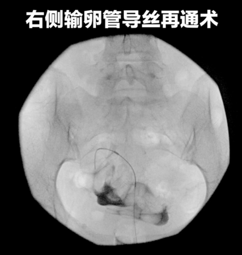 输卵管造影是介入手术吗 输卵管造影是介入手术吗