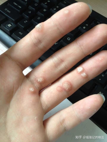 手指疣会传染给别人吗 手指疣会传染给别人吗
