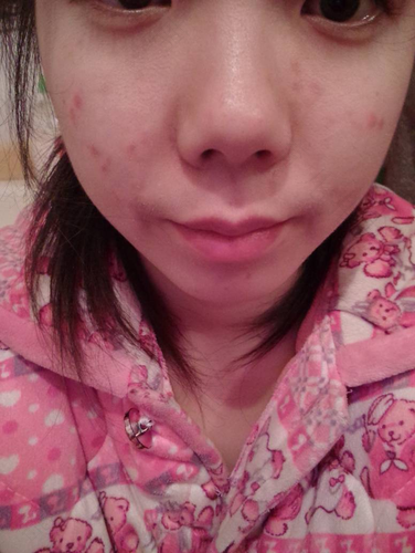 脸上起小红疙瘩不疼不痒怎么回事 脸上起小红疙瘩不疼不痒怎么回事