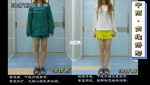 30岁o型腿怎么矫正图解 30岁o型腿怎么矫正图解