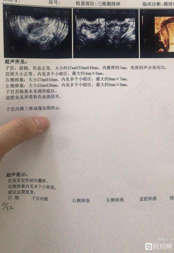 多囊怎么分轻微和严重 多囊怎么分轻微和严重