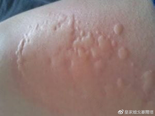 什么是过敏体质 什么是过敏体质