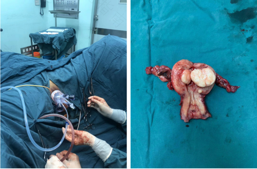 子宫切除半年后还会肠粘连吗 子宫切除半年后还会肠粘连吗