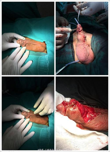 成人尿道下裂手术后多久恢复 成人尿道下裂手术后多久恢复