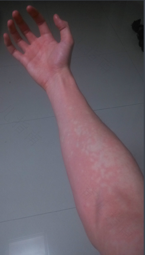 酒精过敏的症状图片 酒精过敏的症状图片