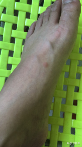 孩子身上起风团是怎么回事 孩子身上起风团是怎么回事