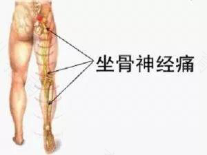 坐骨神经痛的症状 坐骨神经痛的症状