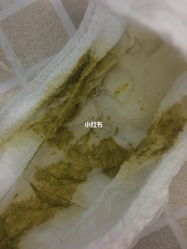 婴儿发烧拉稀拉水怎么办 婴儿发烧拉稀拉水怎么办