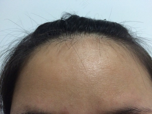 低头额头胀痛怎么办 低头额头胀痛怎么办