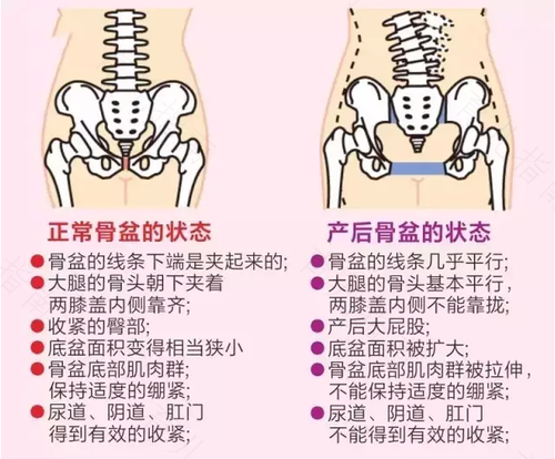 骨盆错位怎样纠正视频 骨盆错位怎样纠正视频